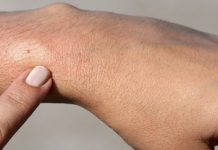 Aντιμετωπίστε τα καλοκαιρινά τσιμπήματα