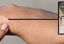 Tο δηλητήριο της μέλισσας και οι θεραπευτικές του ιδιότητες