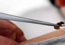 Βελονισμός με δηλητήριο μέλισσας